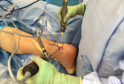achilles-tendon-repair