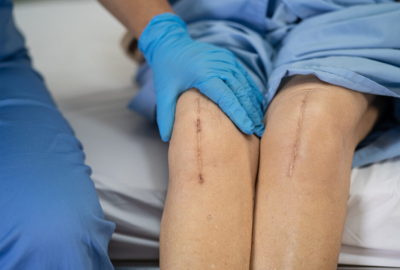 knee-replacement
