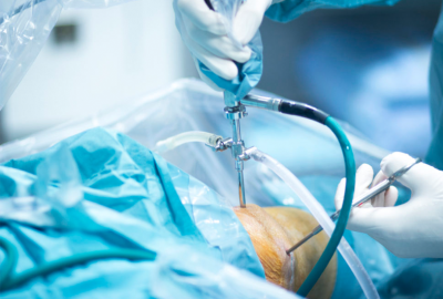 arthroscopy