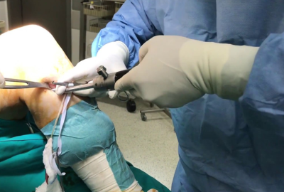 knee-ligament-surgery