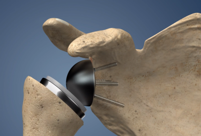 shoulder-replacement
