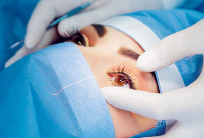 conductive-keratoplasty